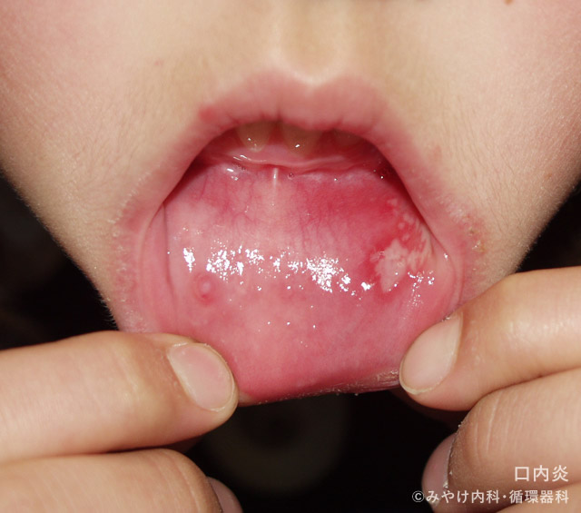 口内炎の原因は?治らない場合の病気との関連や対処法も解説 イシャチョク