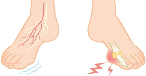 足がじんじんします、ピリピリします、痛風ですか？」痛風や尿酸に関してのよくある質問に答えます。医者が教える病気のブログ