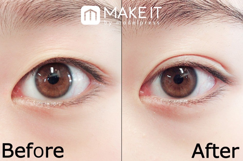 二重にする方法を医師が解説一重・奥二重との違いと自然仕上げのコツ