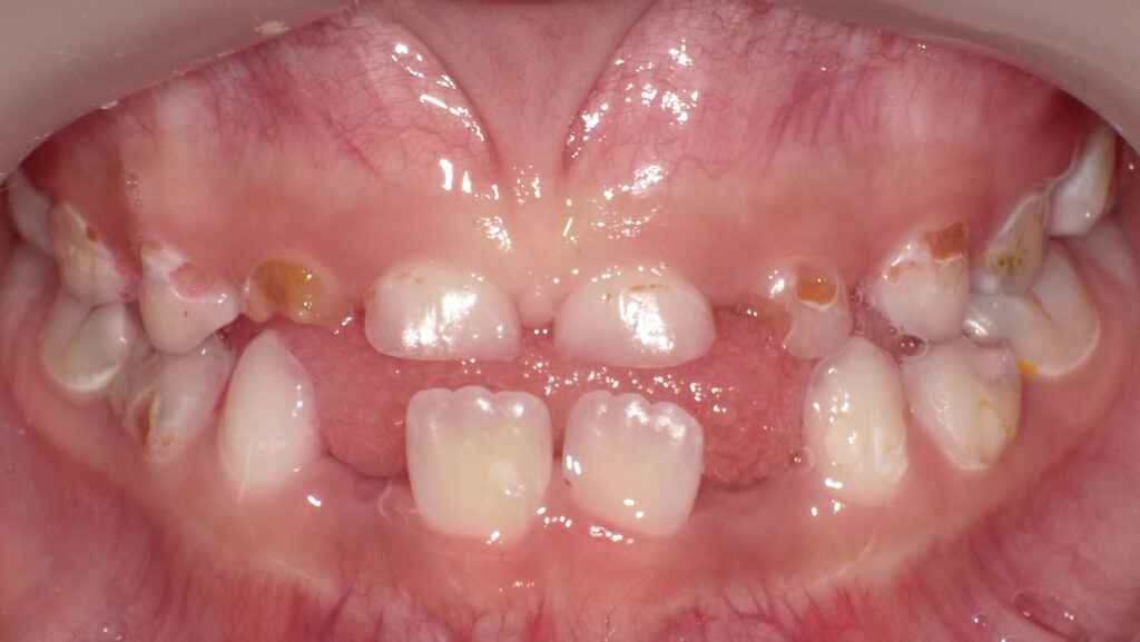 高山市子供の最新虫歯治療は痛くない - 美しく生きるアメリカ歯科標準治療