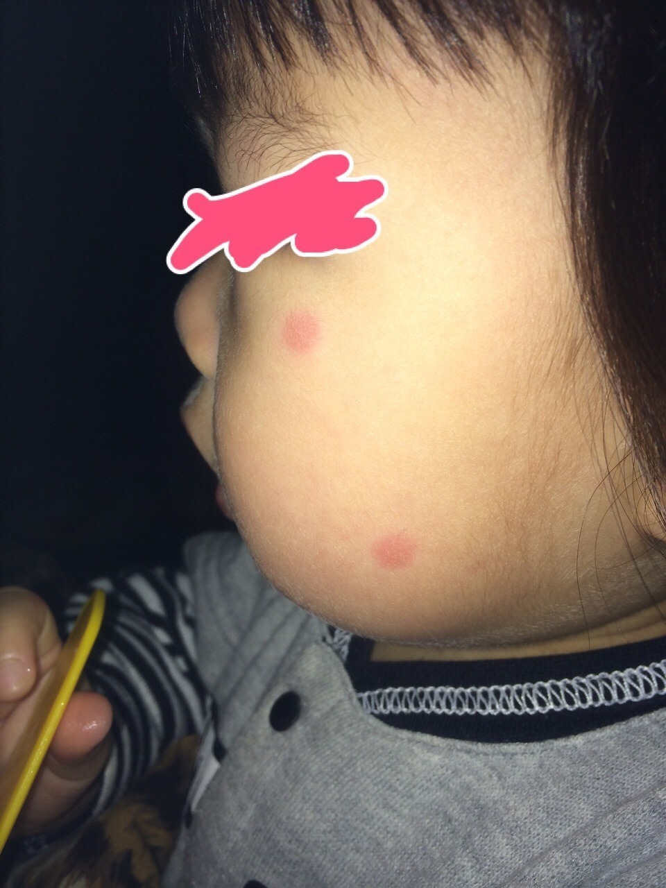 虫刺され町野皮ふ科坂戸市にっさい花みず木の皮膚科