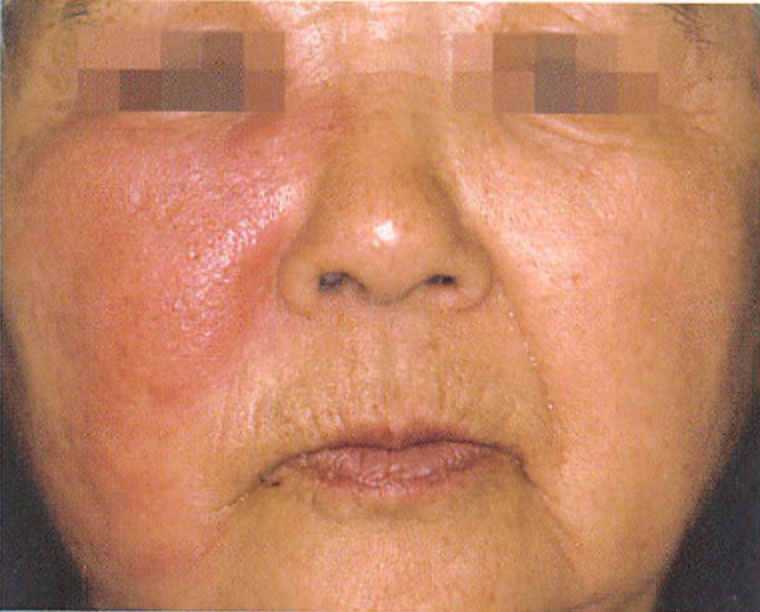 鼻の毛穴のブツブツのクローズアップの写真・画像素材-Snapmart スナップマート