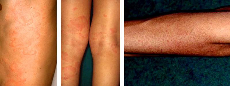 痒疹 ようしん こばとも皮膚科栄駅 名古屋市栄区 徒歩2分