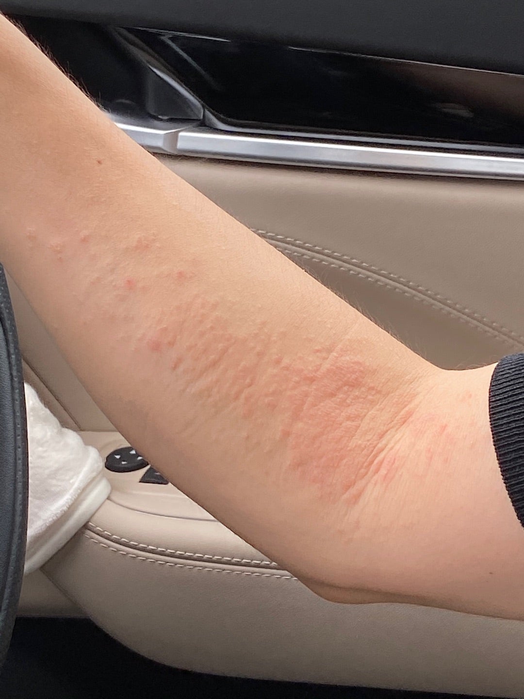 汗疹 あせも足立区西新井駅前の皮膚科アース皮ふ科クリニック