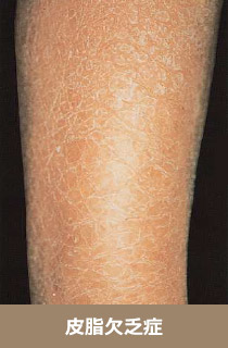 アトピー性皮膚炎目白通り皮フ科