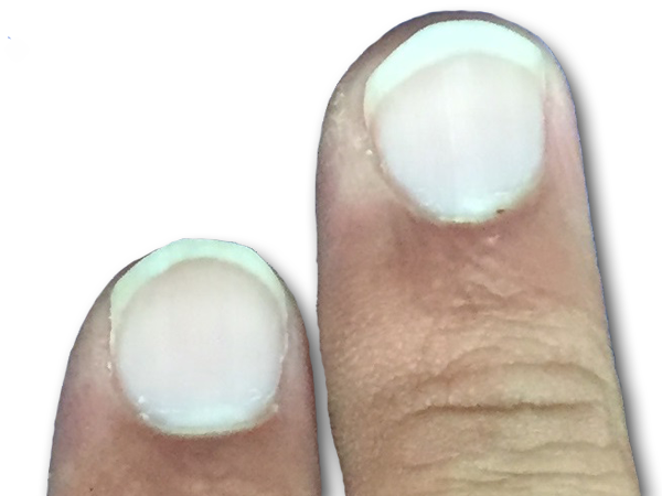 爪の病気 Q5 - 皮膚科Q＆A 公益社団法人日本皮膚科学会