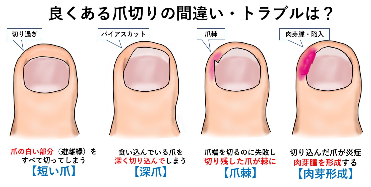 巻き爪 自分で 巻爪 爪切り 巻き爪クリスタルケア 1セット お試し用1個入 軽度・中度用– アスタノシク公式SHOP巻き爪クリスタルケア