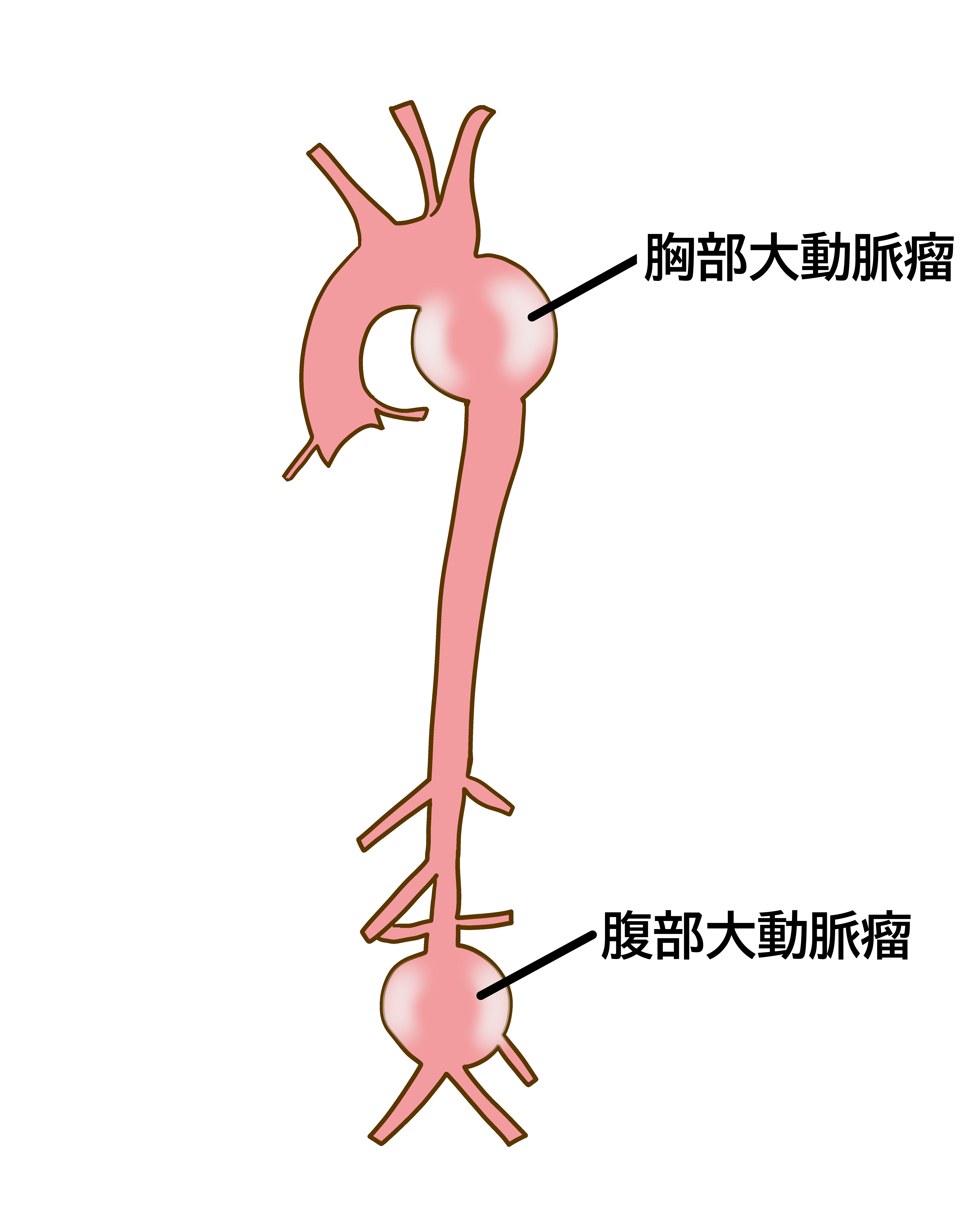 医師監修・作成 大動脈瘤とはどんな病気なのか：症状・原因・検査・治療などMEDLEY メドレー