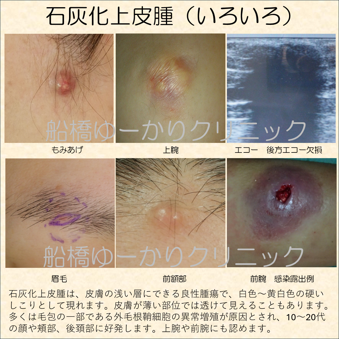 脂腺腫 血管線維腫医療法人あきおか形成外科