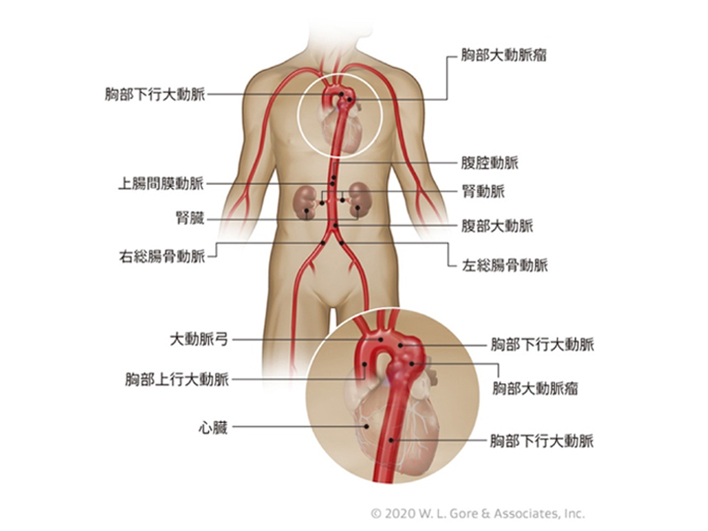 開胸手術と胸部大動脈ステントグラフト手術について心臓血管センター診療科のご案内自治医科大学附属さいたま医療センタ