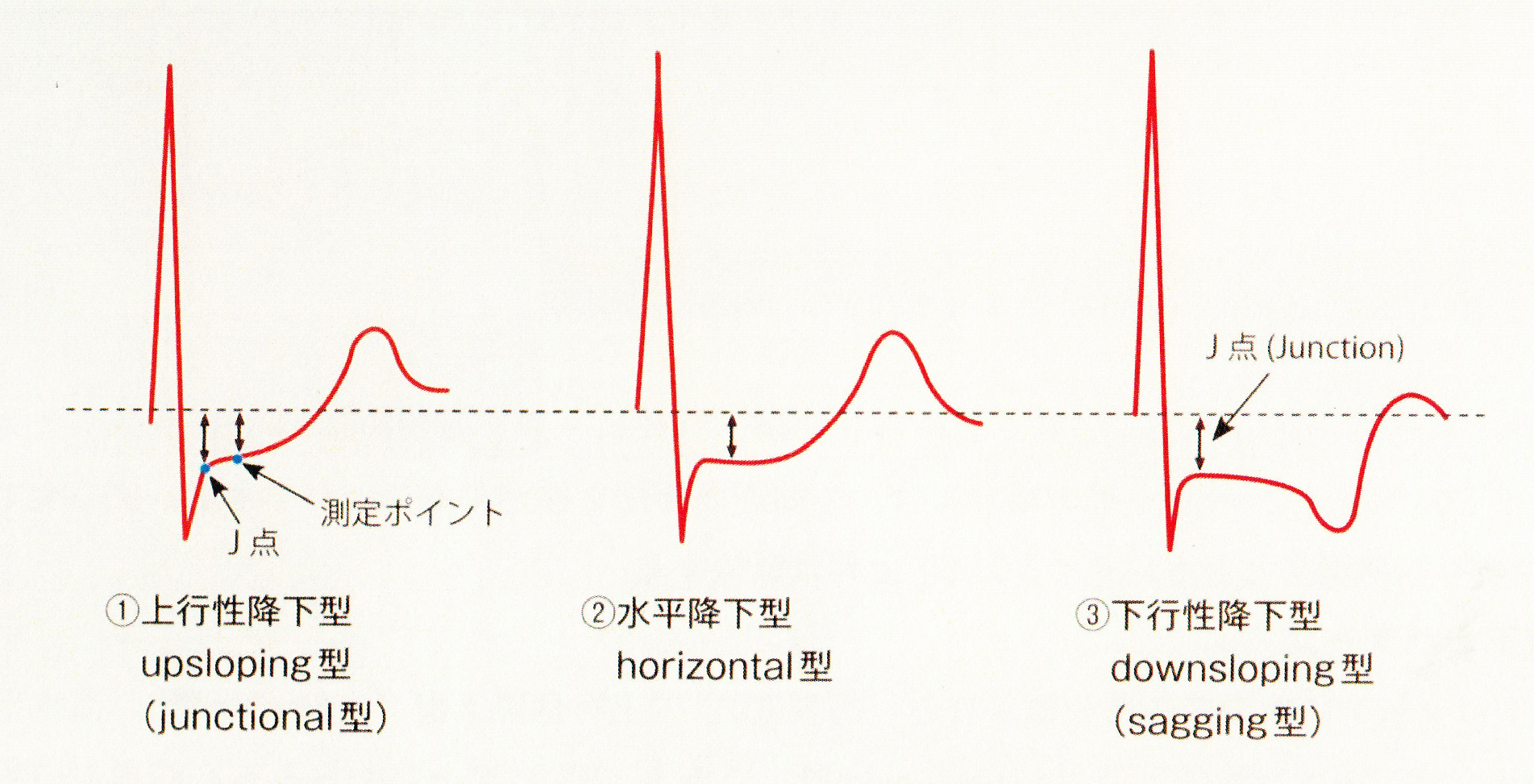 シンプルに考えたら心電図が好きになる！第11回ST変化② ACSサイコロ実践編シンプルに考えたら心電図が好きになる！メディカLIBRARY