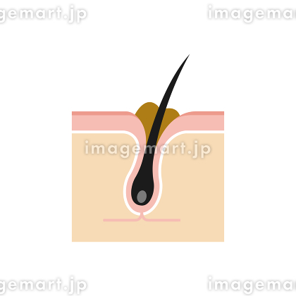 ニキビと正常な肌 毛穴の断面図のイラスト素材64478471- PIXTA