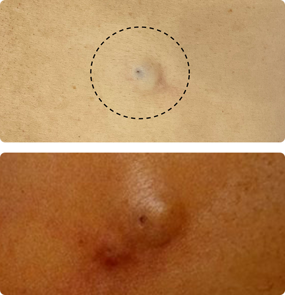 胸にこんな出来物ができたのですが乳がんでしょうかできた当初は痒くてかいていた- Yahoo!知恵袋