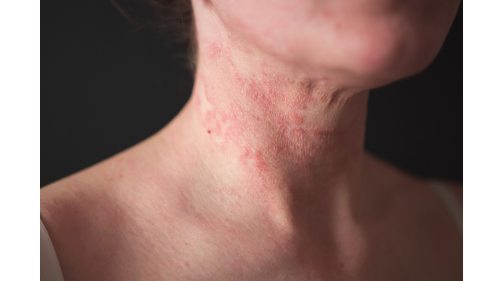 アレルギー性蕁麻疹の症状が出た時の適切な対応方法とは？ - 千葉内科在宅・美容皮膚科クリニック 千葉市稲毛区の内科外来