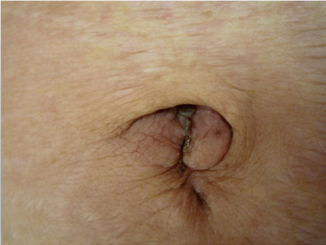 子どものおへその中が赤い「臍炎」の対処。病院は何科？臭い・膿み医師監修kosodate LIFE 子育てライフ