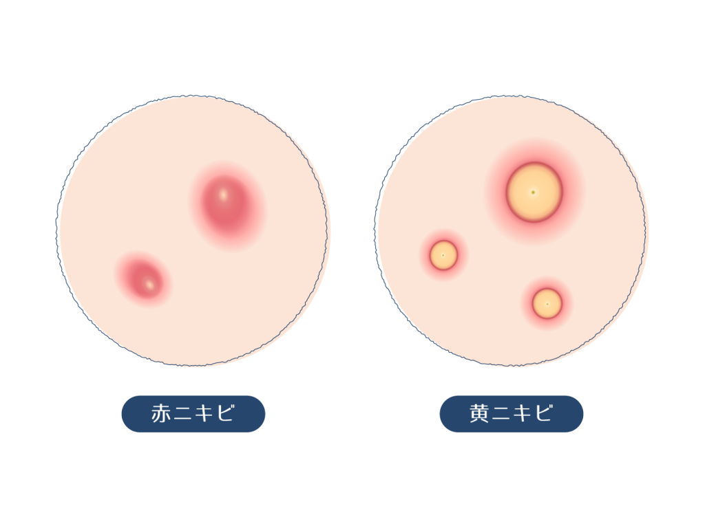 ニキビ 尋常性ざ瘡 吹田市の皮膚科もりはら皮ふ科クリニック