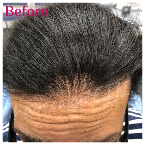 成人男性の3人に1人 深い悩み 薄毛、早め治療で改善期待：東京新聞デジタル