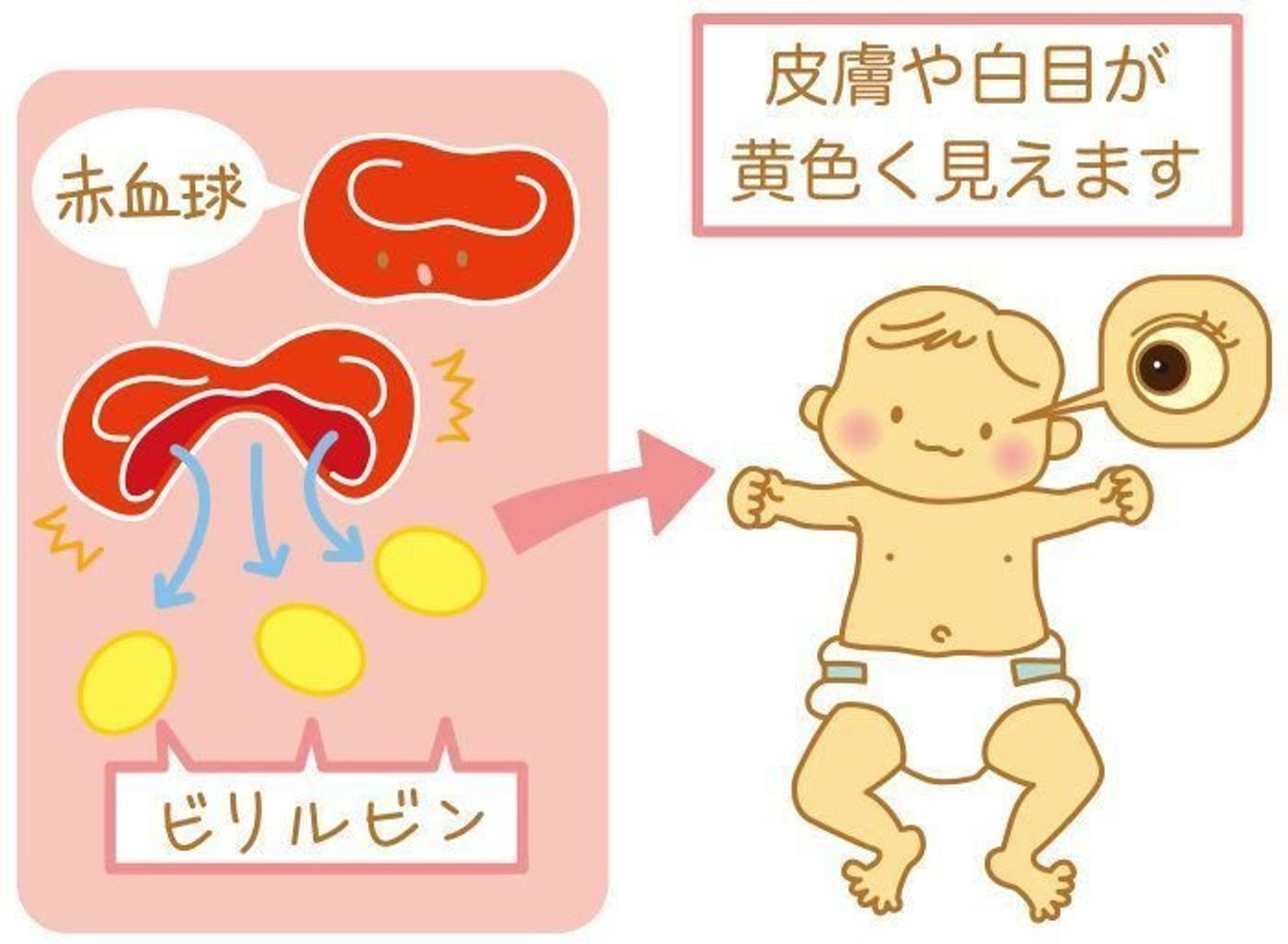 出産４日目 新生児黄疸＠Norieさんのブログ - @cosme アットコスメ