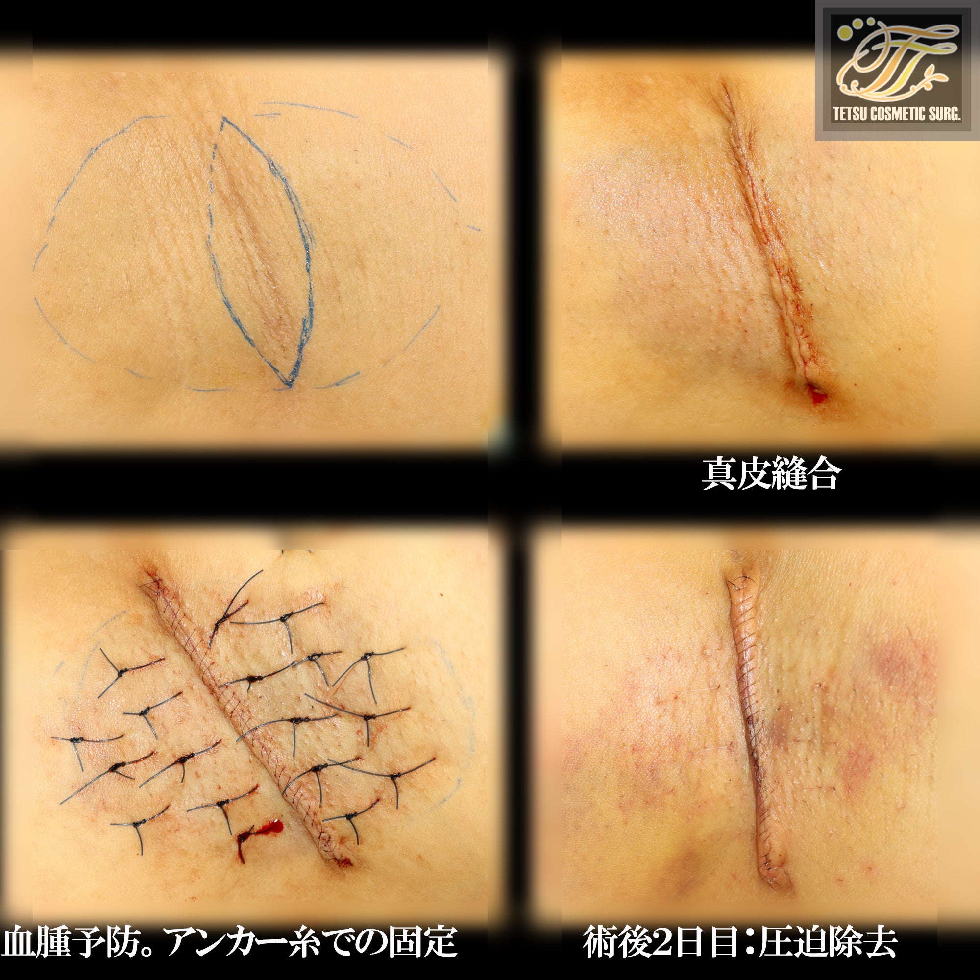 体臭博士が作ったワキガ対策 洗剤 鉛筆の芯 スパイシー系 ワキガ臭 消臭洗剤 400ml×2 ニオイ対策 衣類用 スプレー 洋服 ワキガ 消臭消臭スプレー 洗剤 わきが対策 男性 女性 子供 ワキガ用 洗濯洗剤 腋臭 におい 体臭 汗じみ わき汗 臭い 匂い 対策 改善 洗濯 洗濯用洗剤