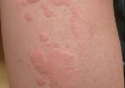 じんま疹の治療うえの皮フ科 - 神戸市灘区の皮膚科・アレルギー科・美容皮膚科