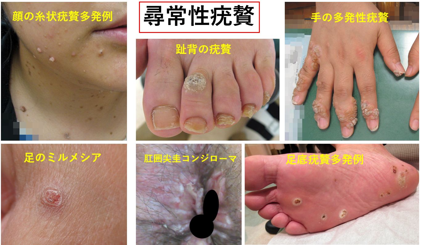 実際の治療映像あり ウイルス性イボ 尋常性疣贅 って何？液体窒素での治療方法を解説