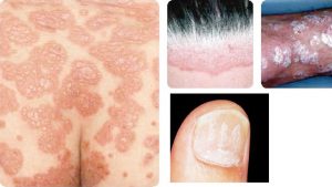 尋常性乾癬 かんせん の原因・予防や治療薬について東京都豊島区の巣鴨千石皮ふ科