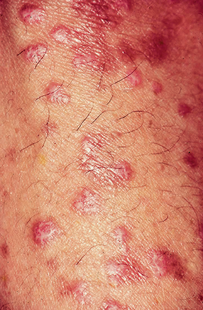 扁平苔癬 へんぺいたいせん 」とは？原因・がん・治療法も解説！メディカルドック