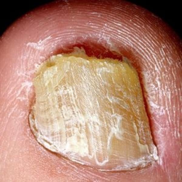 水虫オンライン爪水虫・足水虫に関する情報サイト