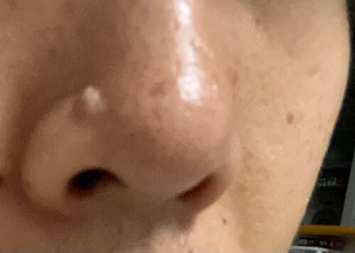 鼻ニキビを即効で治すには？原因と治し方を美容皮膚科医が解説！恵比寿駅徒歩1分の美容皮膚科ATELIER MedicalClinic アトリエメディカルクリニック