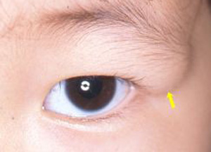 眼瞼黄色腫の手術▽建築と日々喜怒哀楽△