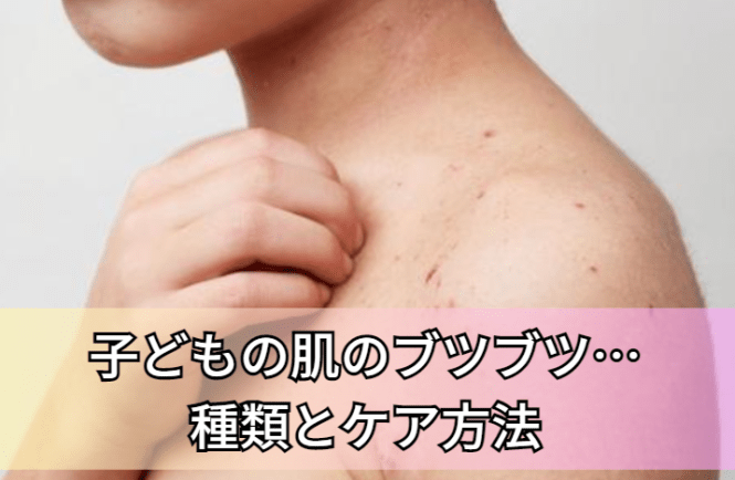 赤ちゃんの鼻の下の湿疹がひどい！３大原因とケアについてやすはら情報局