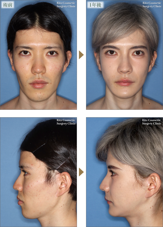 症例写真 頬が痩けた男性にヒアルロン酸を10cc注射して膨らませた症例：美容外科 高須クリニック