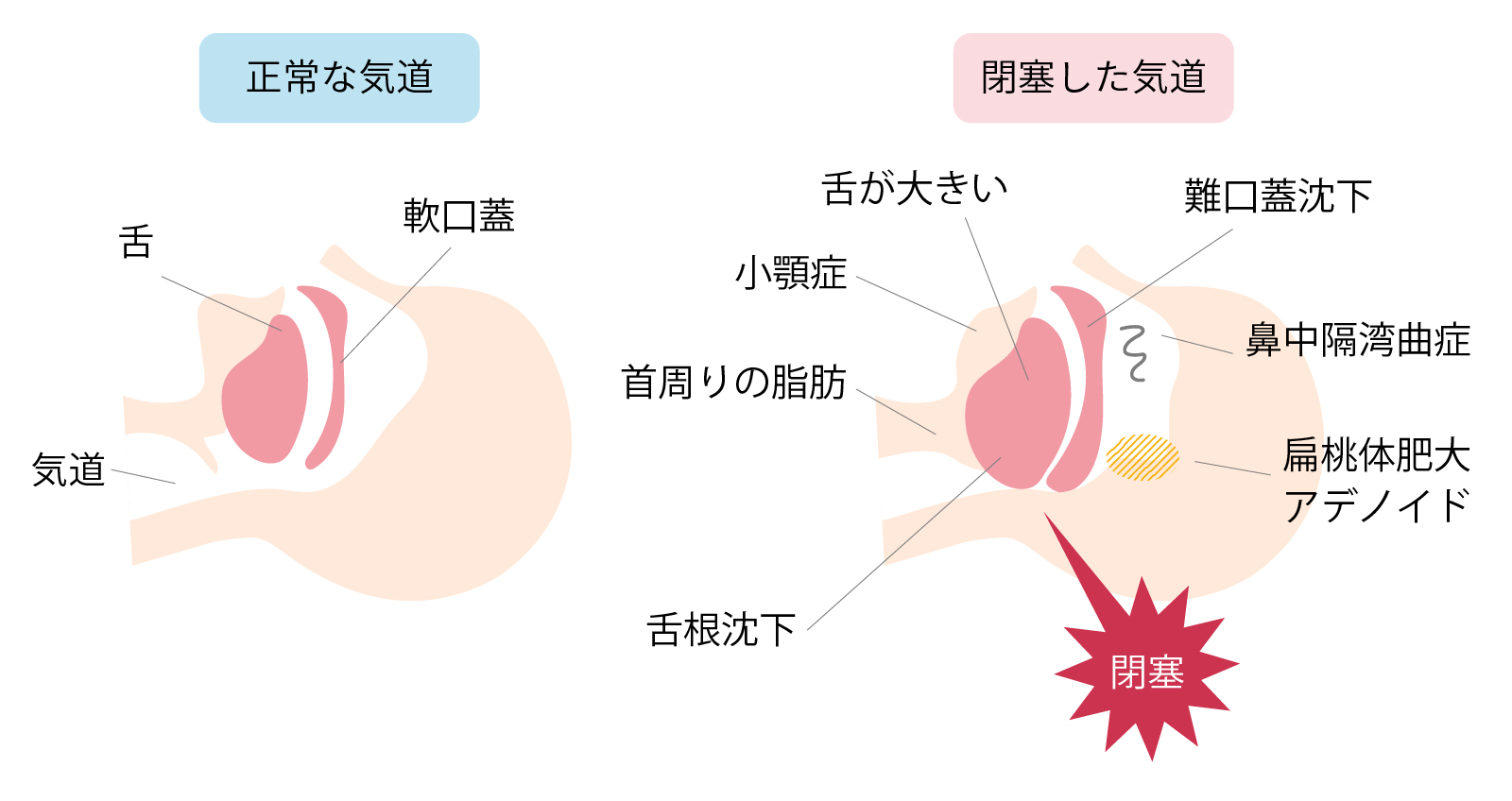 呼吸器疾患情報 - にわもと内科・呼吸器クリニック ブログ