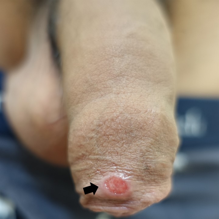 尖圭コンジローマ治療の症例No.5 – メンズ形成外科青山セレス&船橋中央クリニック