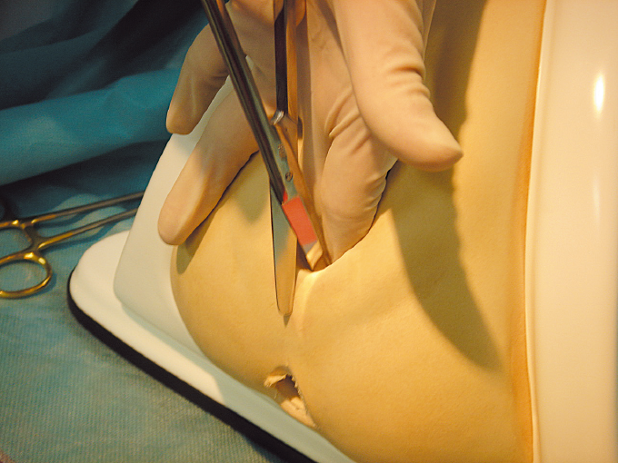 会陰切開後の傷跡の痛み・盛り上がりでお悩みの方へ産婦人科専門医が解説博多駅直結の婦人科 ひよりレディースクリニック福岡博多