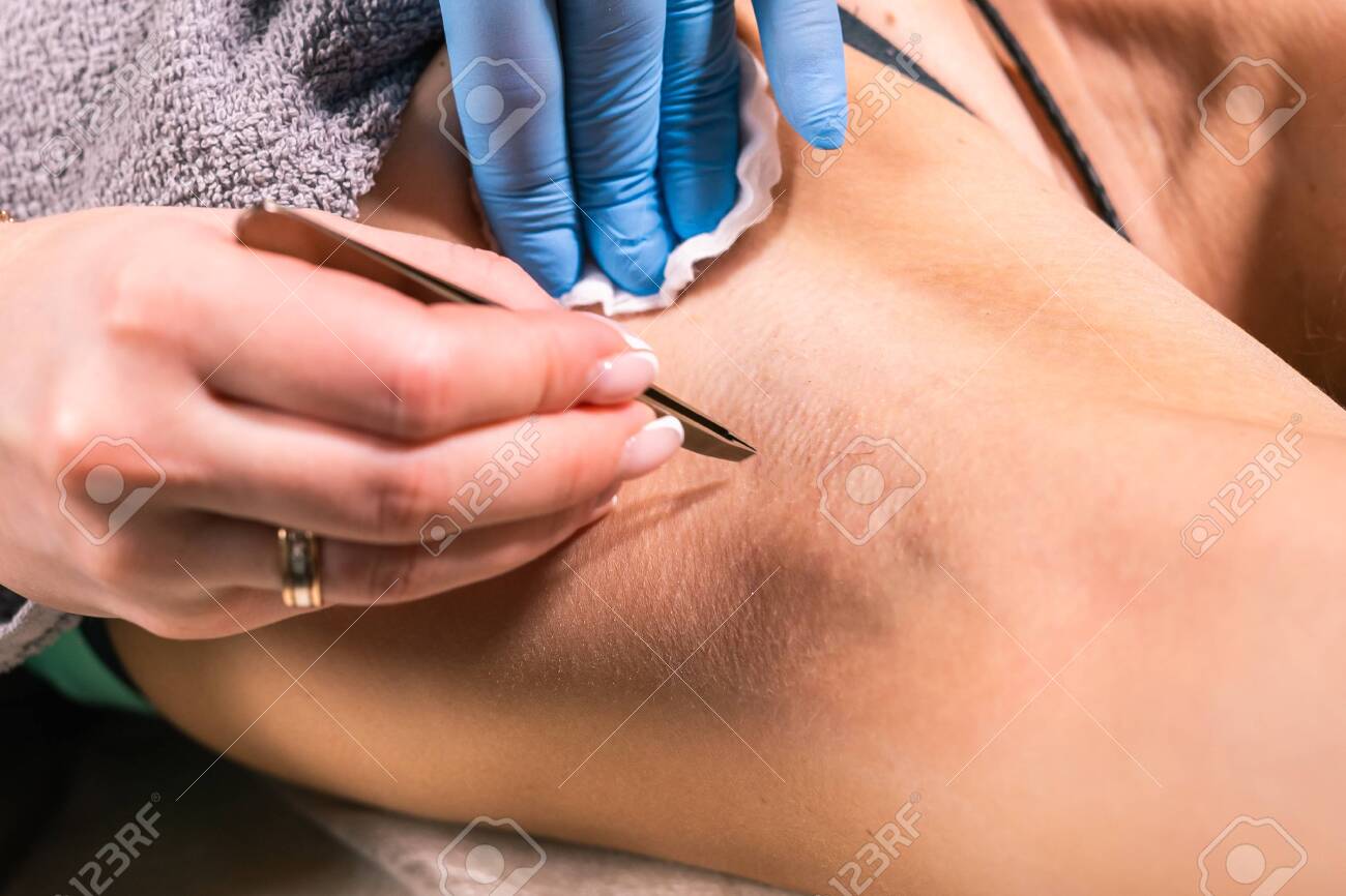 脇のワックス脱毛 施術例 施術当日ビフォーアフターワックス脱毛サロン holica