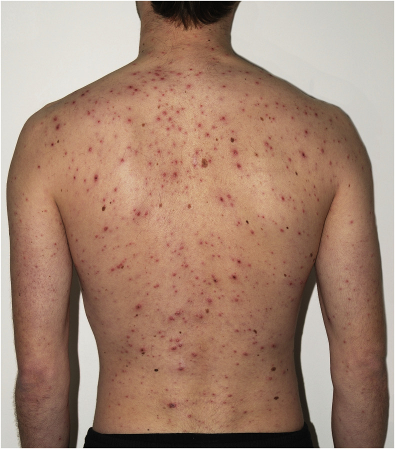 コロナに伴う皮膚症状 COVID-19〜誰でもわかる優しい感染対策〜 - YouTube