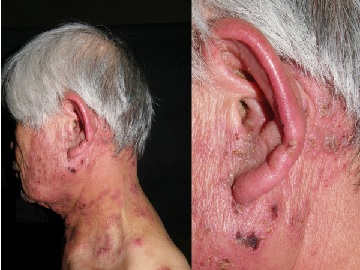 耳が痛いのは帯状疱疹かも？耳帯状疱疹 ラムゼイ・ハント症候群 とはオンライン診療・服薬指導サービス SOKUYAKU ソクヤク