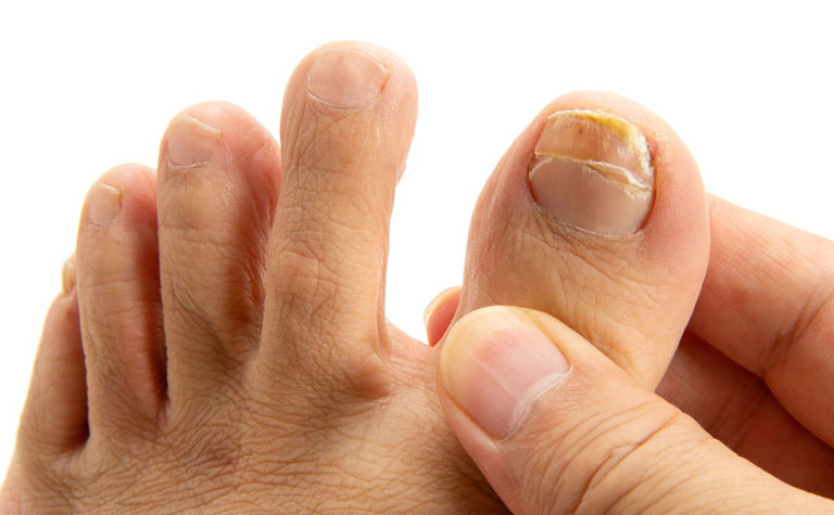 足や爪の病気ＭＹ介護の広場