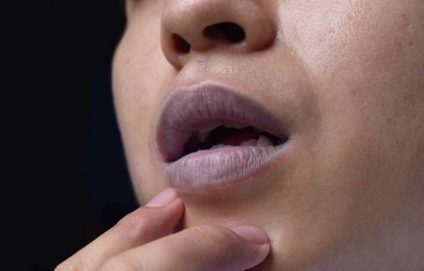 先天性心疾患を有する東南アジアの高齢者におけるチアノーゼ性口唇または中枢性チアノーゼ。写真素材2122881734Shutterstock