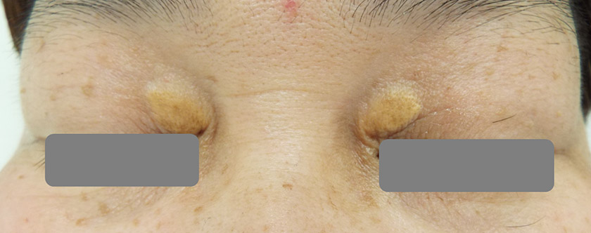 高脂血症 脂質異常症川崎市幸区の川崎中央クリニック 矢向駅すぐの整形外科・頭痛外来・めまい外来・脳神経外科・脳ドック・内科・消化器内科・循環器内科