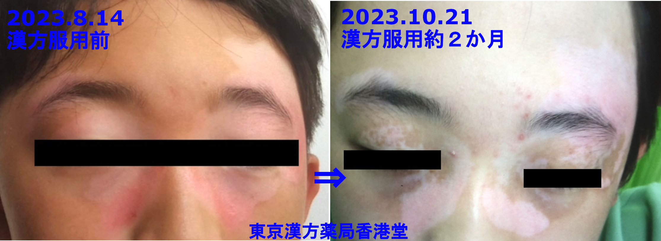 白斑外来東京医科大学 皮膚科学分野