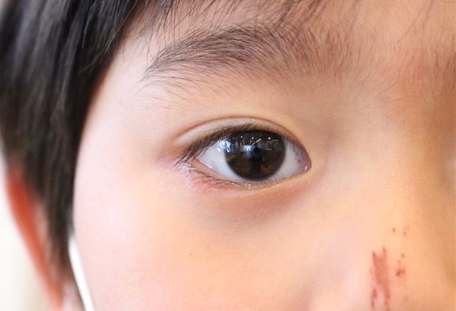 ウイルス性結膜炎日本眼科学会による病気の解説