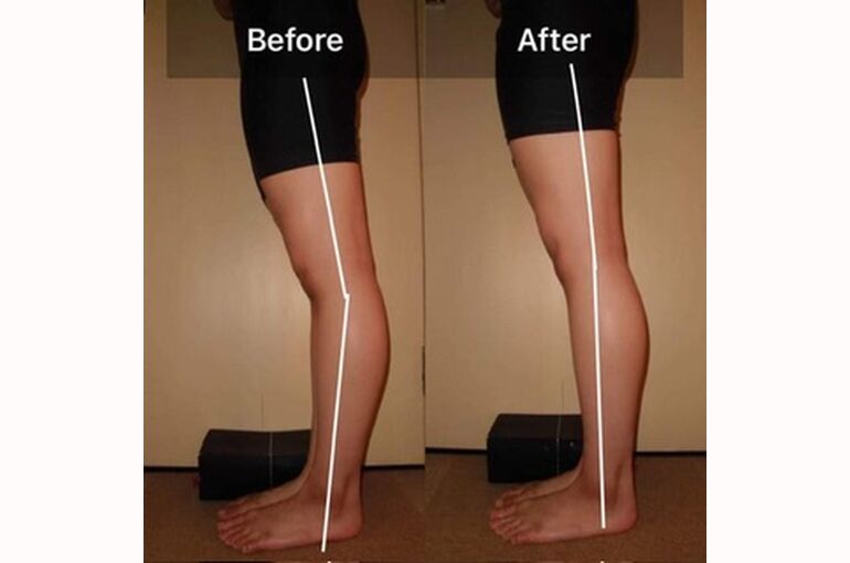 反張膝 ！「今すぐやめて〜〜！ - eigonだって泳ぎたい あひる解剖学