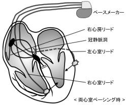 終末期における心臓の植え込み型除細動器－必要なときと必要でないときメディカルノート