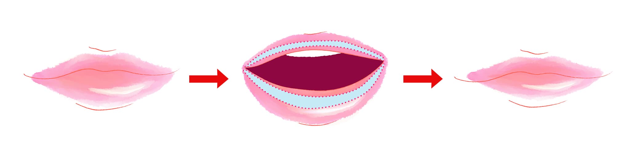 M字リップ形成術と唇縮小術eクリニック岡山院 公式 美容整形・美容外科