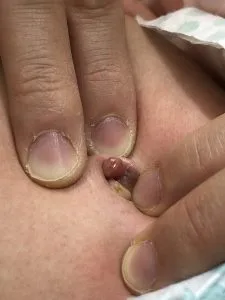 尿膜管遺残診療部門のご案内地方独立行政法人 市立吹田市民病院