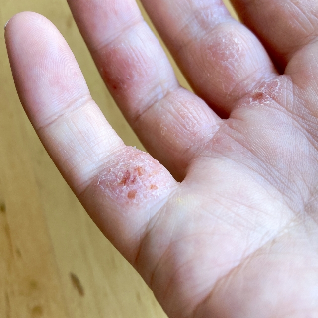 あせも 汗疹 ひふ研第一三共ヘルスケア