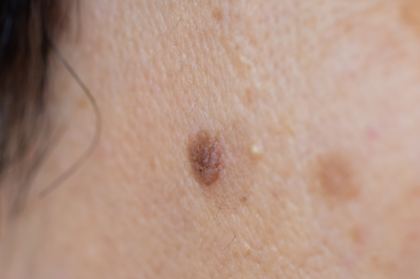 ウイルス性イボ 尋常性疣贅 とは 治療など新宿駅前クリニック皮膚科