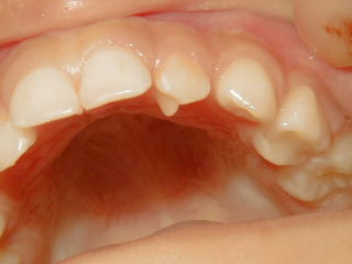 奇形歯「歯内歯」